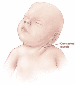 infant torticollis pillow